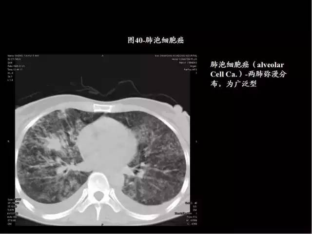 為什么做胸、腹部CT掃描時(shí)需要吸氣-屏氣-吐氣？