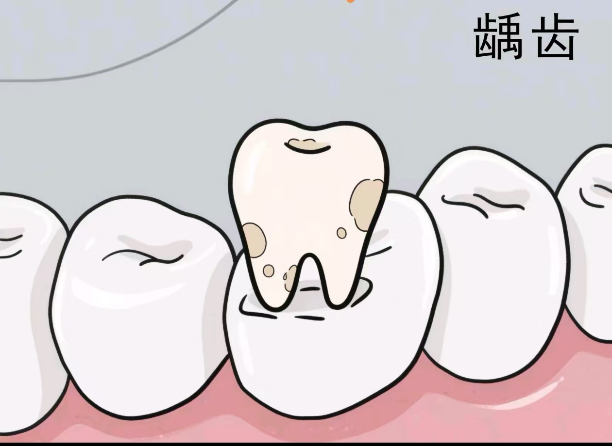 關(guān)于干燥綜合征齲齒的那些事兒