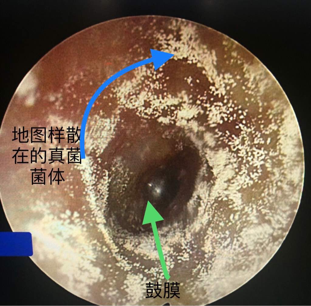 耳朵里長(zhǎng)“蘑菇”？當(dāng)心真菌性外耳道炎！別亂掏，這樣做才正確！