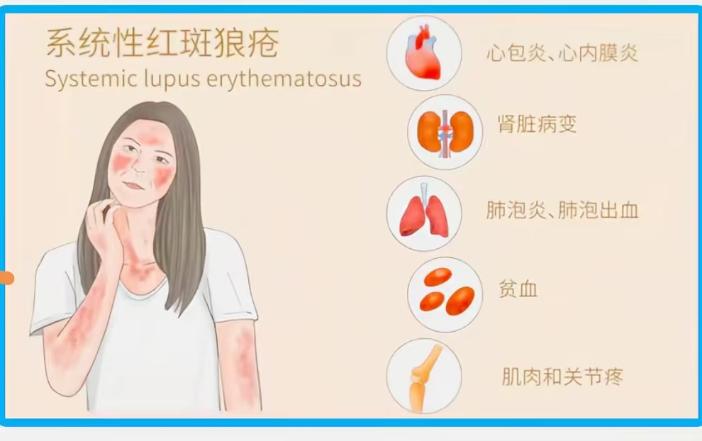 為什么這么年輕會得紅斑狼瘡？