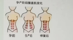 女性產(chǎn)后大肚腩一都是腹直肌分離惹的禍
